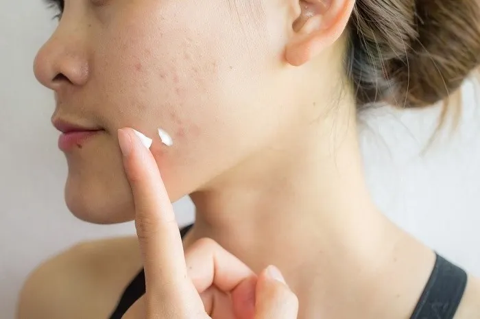 giảm mụn tại nhà