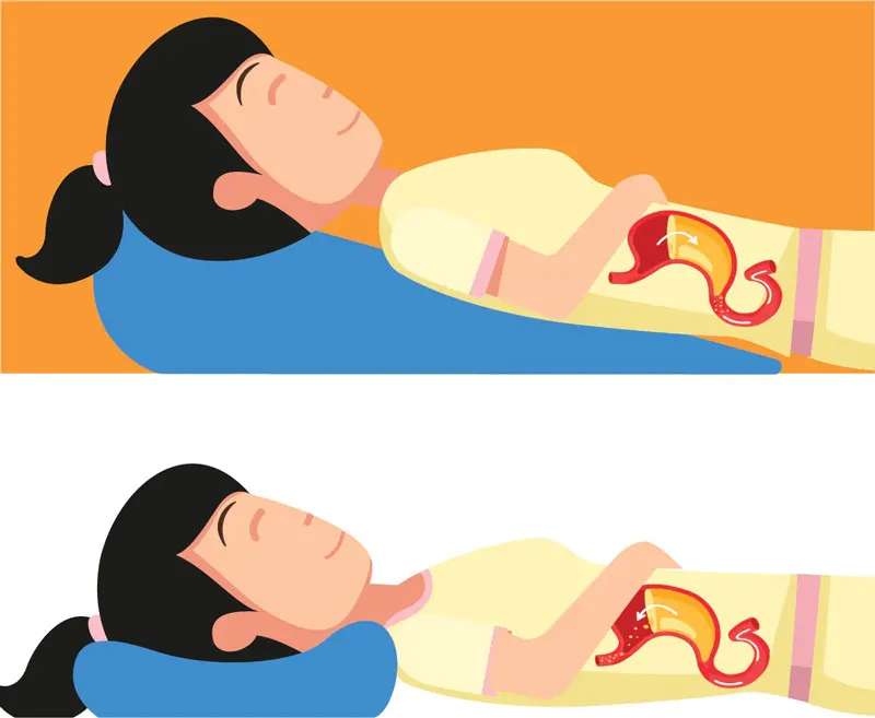 Kê cao đầu khi ngủ giúp giảm trào ngược dạ dày thực quản