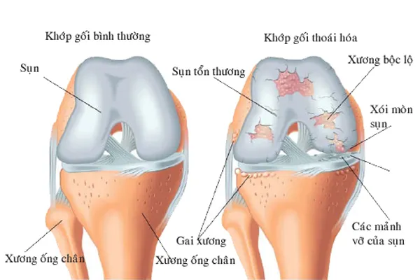 Khớp bình thường và khớp bị thoái hóa (khớp gối)