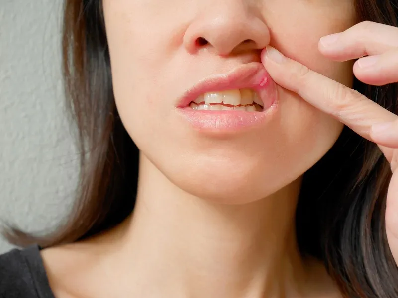 Giải đáp thắc mắc người bị nhiệt miệng nên ăn gì và kiêng gì?