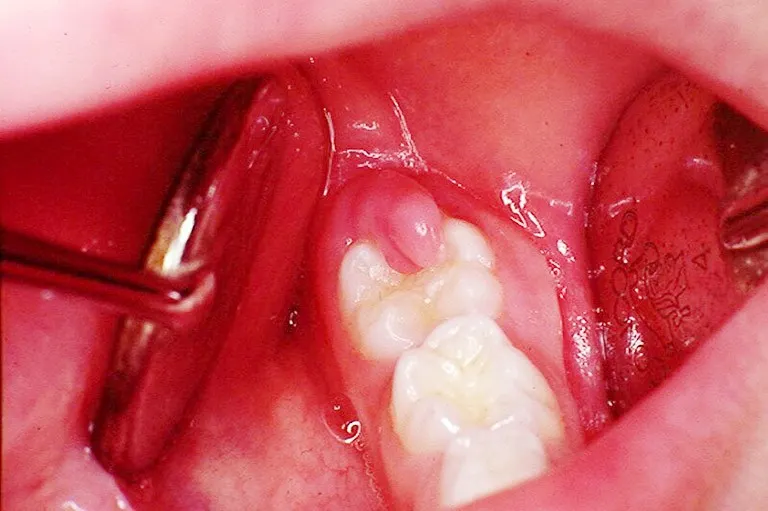 sưng lợi mọc răng khôn
