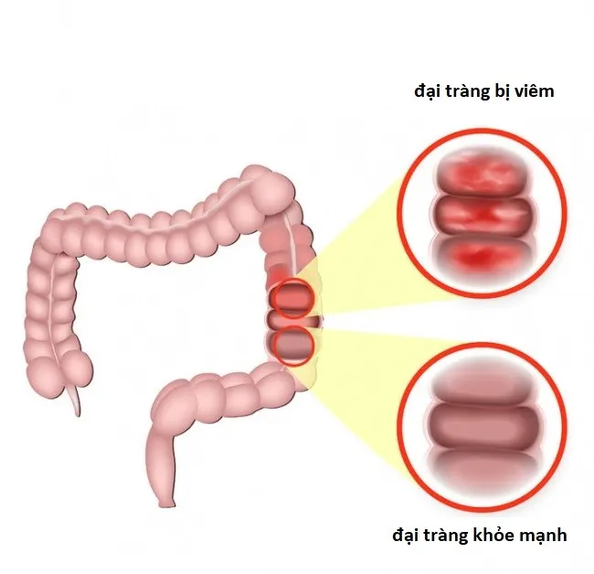  Sôi bụng tiêu chảy nhiều lần
