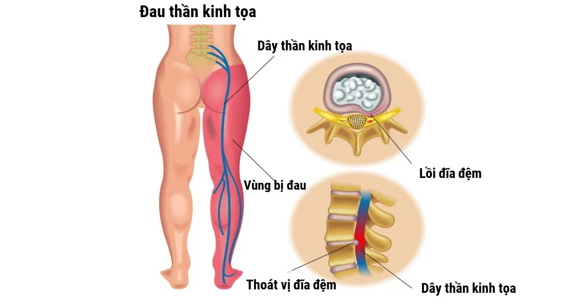 tê tay chân