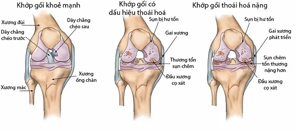 thoái hóa khớp gối 
