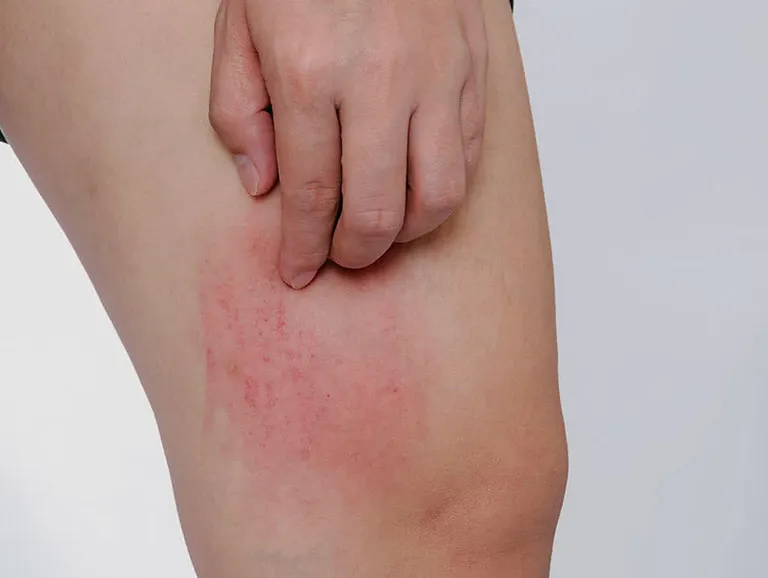 Triệu chứng khi bị nổi mẩn ngứa ở chân