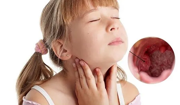 viêm amidan quá phát ở trẻ em