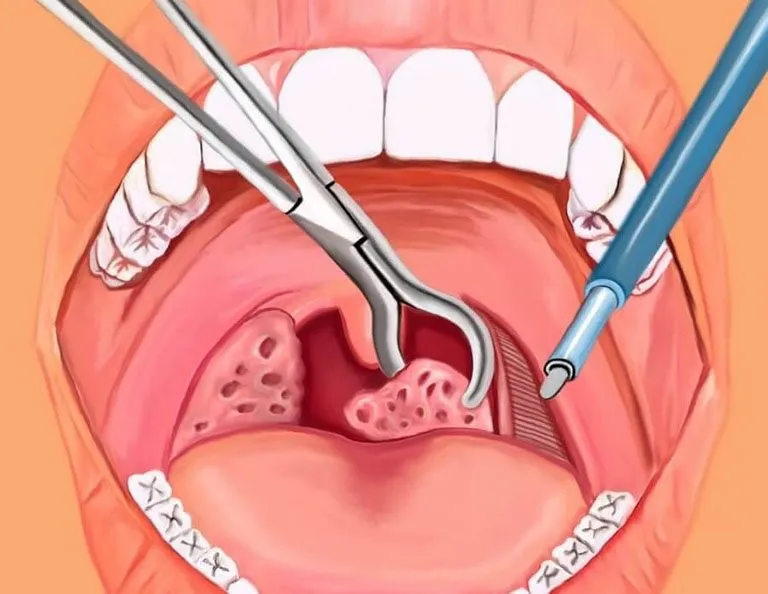 viêm amidan quá phát ở trẻ em