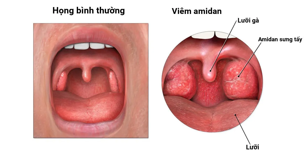 viêm amidan quá phát ở trẻ em