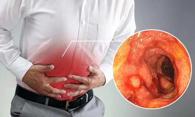 viêm đại tràng mãn tính có chữa được không