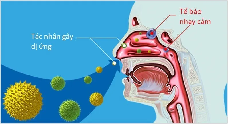Chữa viêm mũi dị ứng