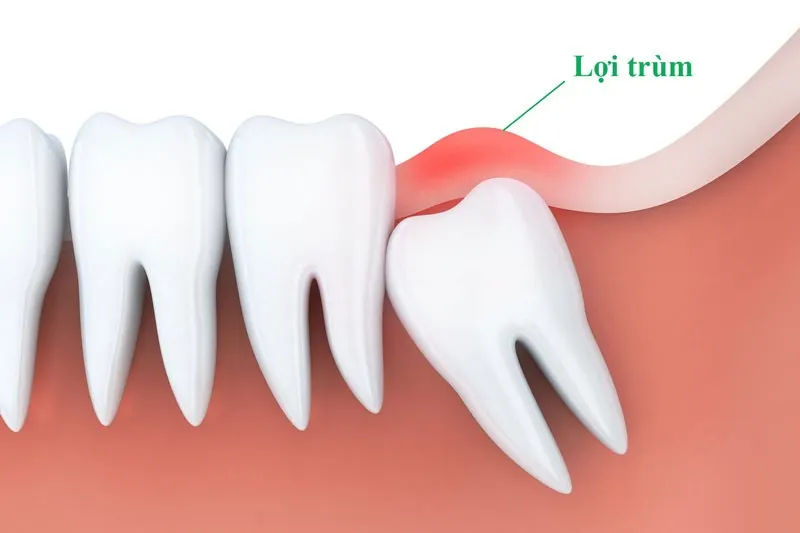 viêm lợi trùm răng khôn