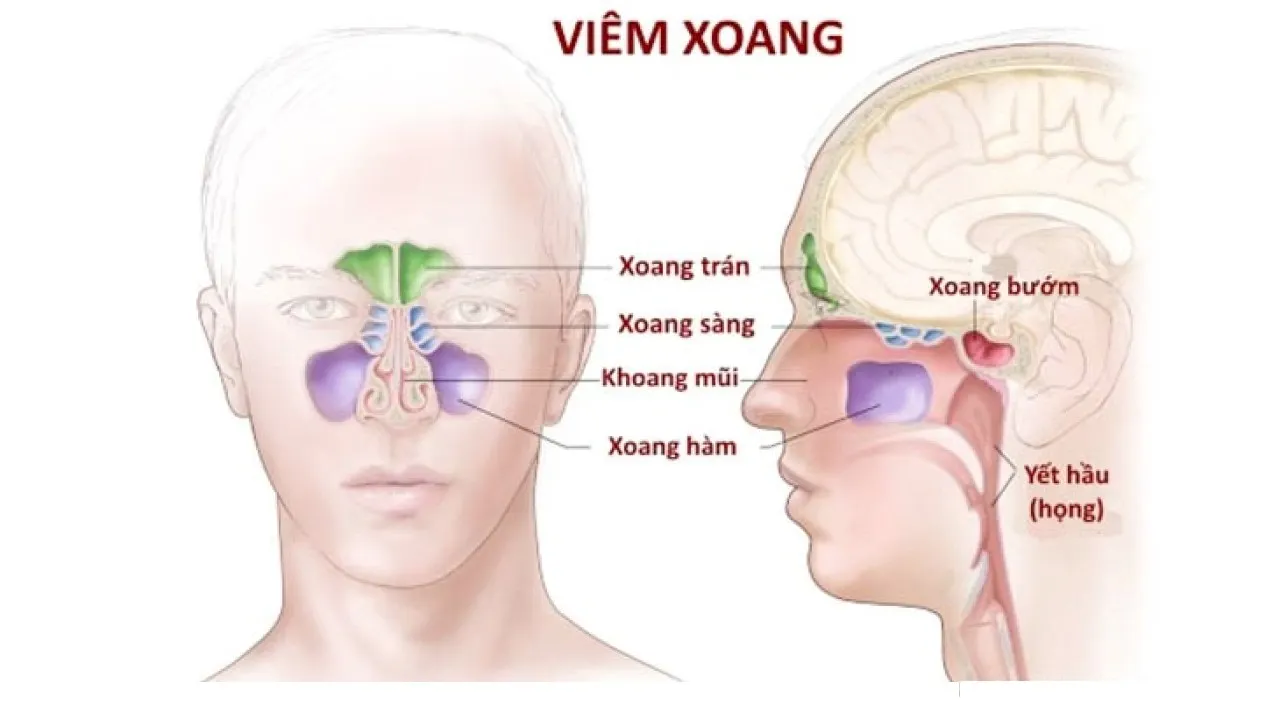 viêm xoang sàng