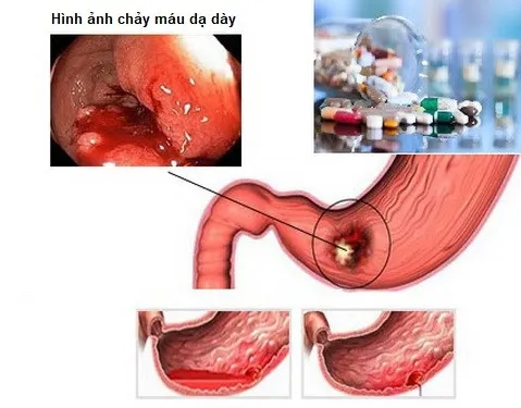 xung huyết dạ dày là gì