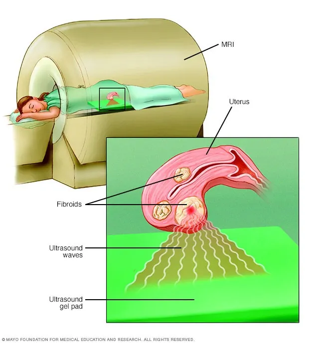 Ảnh: Kỹ thuật MRI phẫu thuật siêu âm tập trung (FUS)