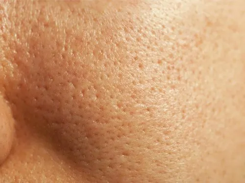 Ai sở hữu làn da nhờn sẽ đi đôi với lỗ chân lông lớn