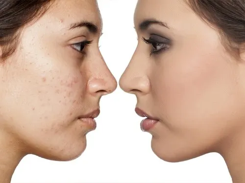 Lỗ chân lông to và bị tắc thì có thể xuất hiện mụn